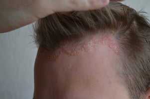 psoriazis scalp