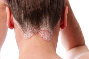 psoriazis scalp